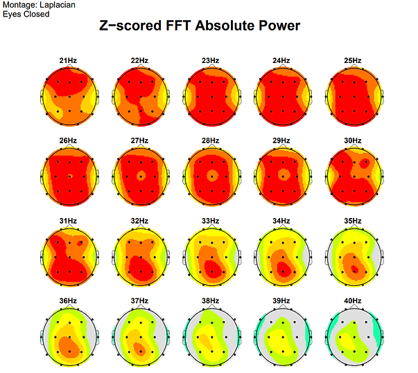 Session 1 — Z-score qEEG map